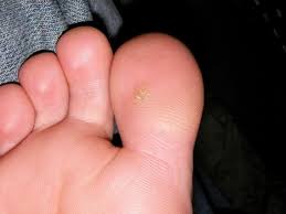 how to get rid of warts fast home