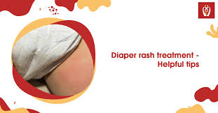 diaper rash treatment helpful tips
