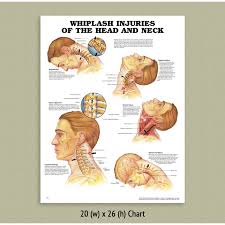 Back Talk Systems Colorado Whiplash Anatomical Chart