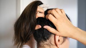 relieve itchy scalp and dandruff