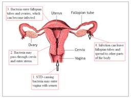 ` pain in the lower pelvis on one or both sides, especially during menstrual periods. Pelvic Inflammatory Disease