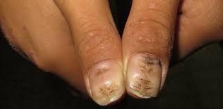 nail disorders and diseases quiz