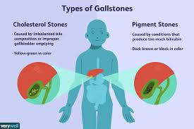 Gallstones Symptoms Causes Diagnosis And Treatment
