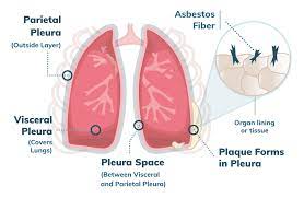 It can take 20 to 50 years for mesothelioma to appear after first . Pleural Mesothelioma Stages Treatment Prognosis