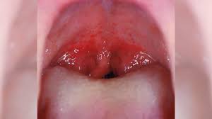 is it strep throat pictures and symptoms