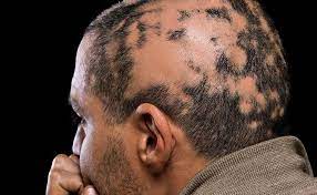 Risk factors include a family history of the condition. 10 Things You Didn T Know About Alopecia Prevention