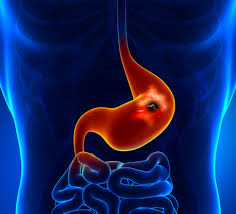 stomach ulcer peptic ulcer medlineplus
