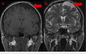 magnetic resonance imaging of the brain