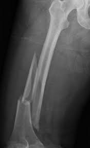 Winquest classification of femoral shaft fracture (case courtesy of dr benoudina samir, radiopaedia.org. Femoral Shaft Fractures Springerlink