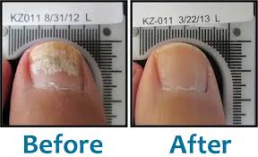 lunula fungal nail cold laser treatment