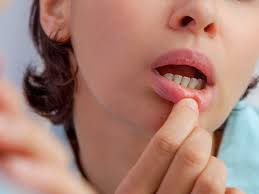 white spots on gums causes treatment