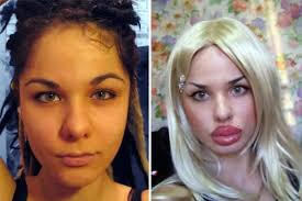 woman gets 100 silicone injections to
