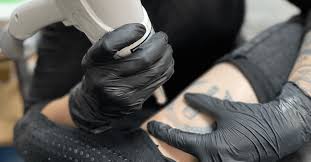 laser tattoo removal faqs winterpark