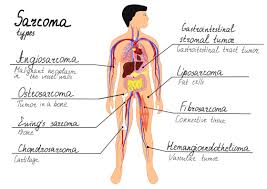 sarcoma symptoms diagnosis and treatment