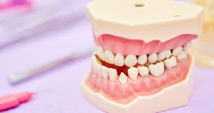 Depending on the severity of the underbite, it may be necessary to extract one or more teeth of the lower jaw to give the remaining teeth room to move. How To Fix An Underbite Las Vegas Nevada Dentistry Braces