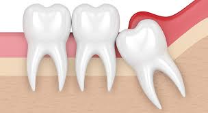 wisdom tooth pain causes and cures