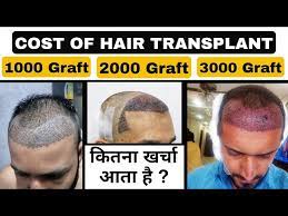 cost of hair transplant 1000 2000