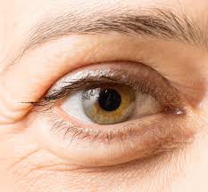 droopy eyelids blepharoplas