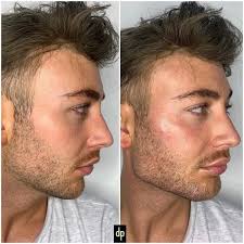 The accurate placement of an appropriately selected hyaluronic acid (ha) dermal filler at the it is important to recreate the angular contours as the face transitions inferiorly from the jawline to the neck. Jawline Fillers Derma Plus Aesthetics