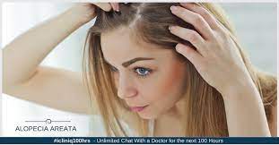 alopecia areata patchy hair loss with