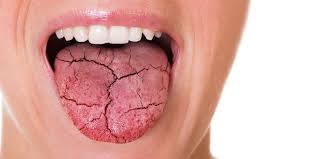what is causing the dry mouth epidemic
