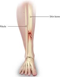 shinbone fractures atlanta tibia pain