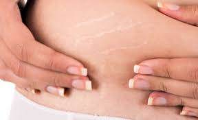 stretch mark removal causes