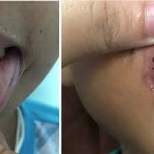 black spots on the lips of the patient