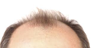 itchy scalp dandruff symptoms