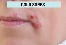 cold sores pictures of what they look