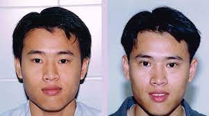 Eyelid Surgery Before and After Photos, Focusing on Asians