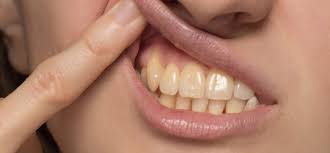 home remes to get rid of yellow teeth