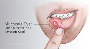 dental cysts what are they and how