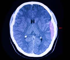 Subdural hemorrhages are believed to be due to. Subdural Vs Epidural Hematomas Diller Law Personal Injury Law