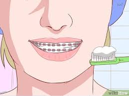 The taste of the medication may be unpleasant, but it is an effective way to numb the mouth pain from braces. How To Avoid Pain When Your Braces Are Tightened 14 Steps