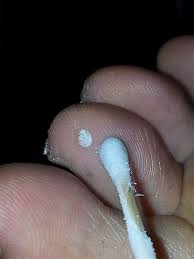 cryotherapy wart mole removal u s