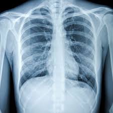 Maybe you would like to learn more about one of these? Chest X Ray For The Diagnosis Of Lung Cancer
