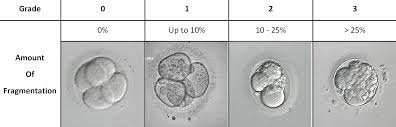 Choosing Embryos For Transfer Or Freezing Fertility Solutions
