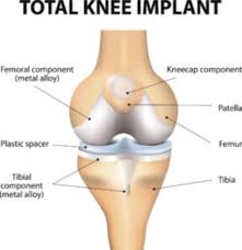 total joint replacement joi