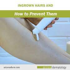 ingrown hairs and how to prevent them