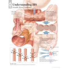 Understanding Ibs Irritable Bowel Syndrome Chart