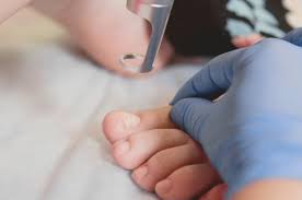 laser treatment for fungal nail