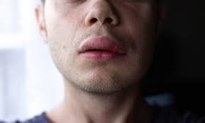 photo angioedema allergic reaction