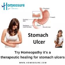 Watch how a polyp is removed during a colonoscopy to prevent colon and rectal cancer. What Are Some Natural Remedies For Stomach Ulcers Quora