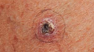 what is basal cell carcinoma skin cancer