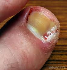 Toenail falling off from fungus. What Causes Black Toenails With Pictures