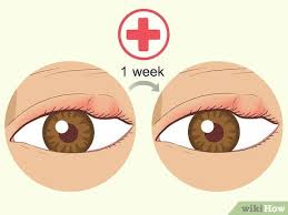 18 ways to get rid of puffy eyelids