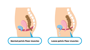 pelvic floor dysfunction and back pain