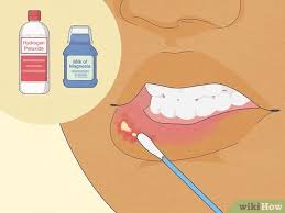 how to remove a mouth ulcer 10 ways