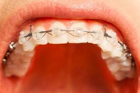 swollen gums with braces